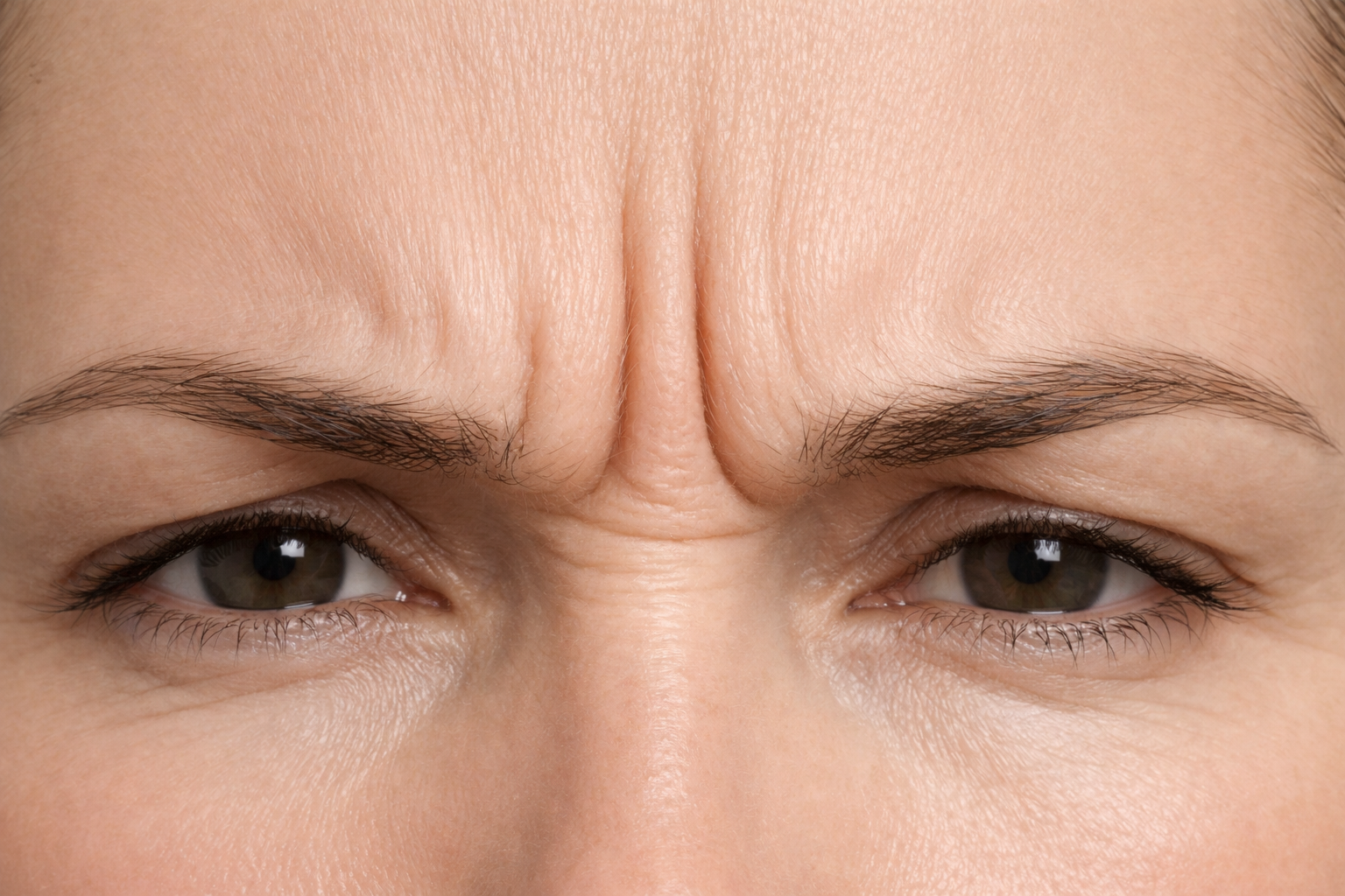Deep frown lines between the eyebrows, known as glabellar lines or elevens