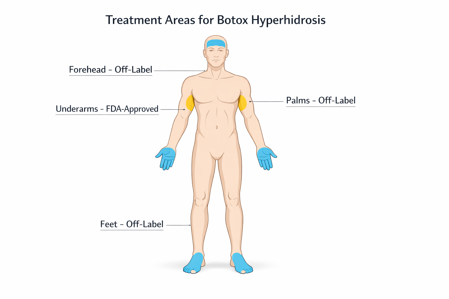 Body map showing Botox hyperhidrosis treatment areas including underarms, palms, feet and forehead
