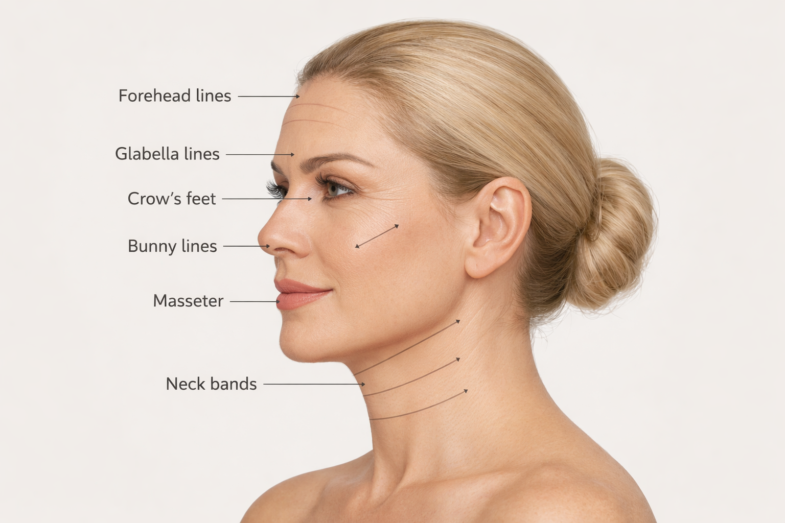 Diagram of common Botox injection treatment areas on the face and neck
