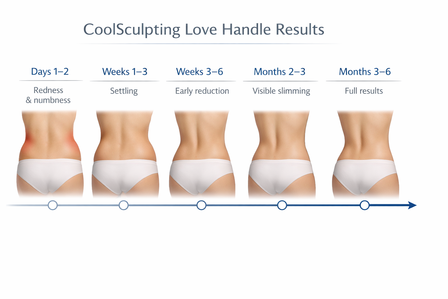 CoolSculpting love handles results timeline from days 1-2 through months 3-6