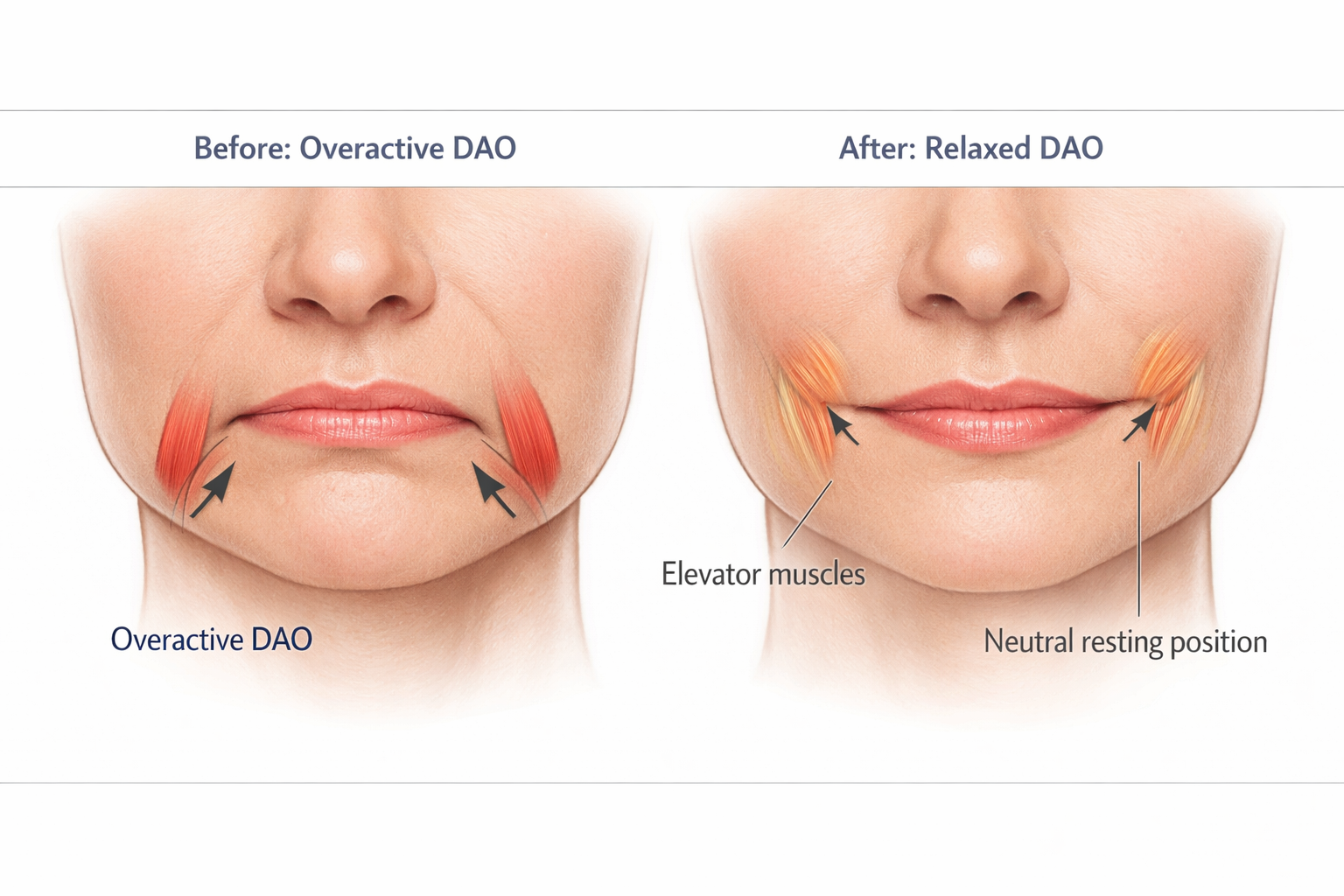 Diagram showing DAO muscle before and after Botox treatment lifting drooping mouth corners