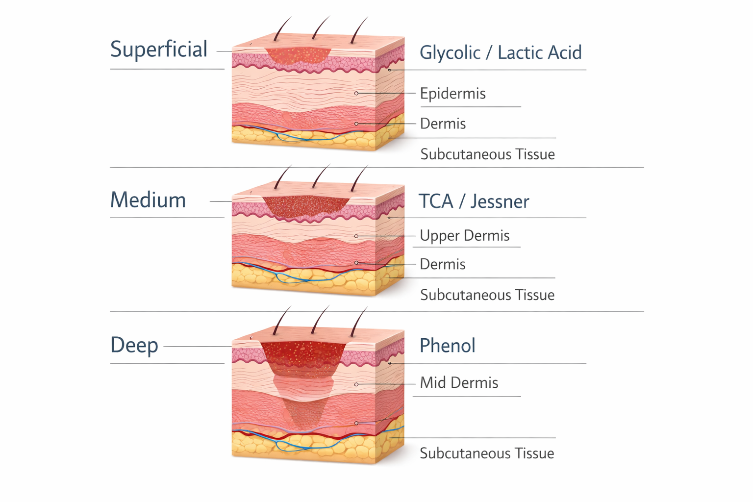 Diagram showing superficial, medium, and deep chemical peel depth levels in skin layers