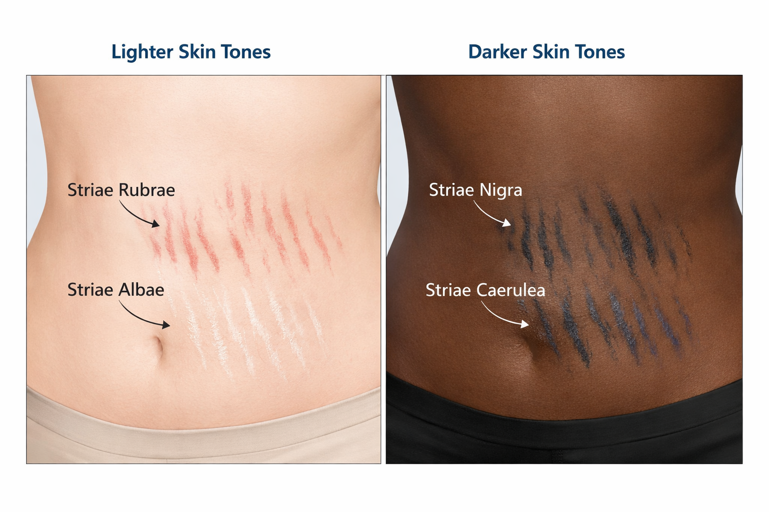 Illustration comparing stretch mark appearance on lighter versus darker skin tones including