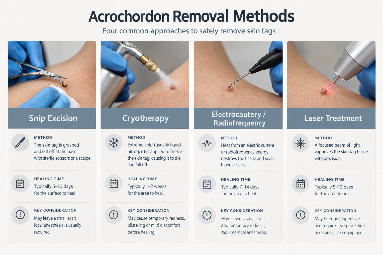 Comparison infographic of four skin tag removal methods: snip excision, cryotherapy