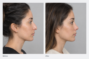 Botox nose lift before and after side profile illustration showing subtle nasal tip elevation