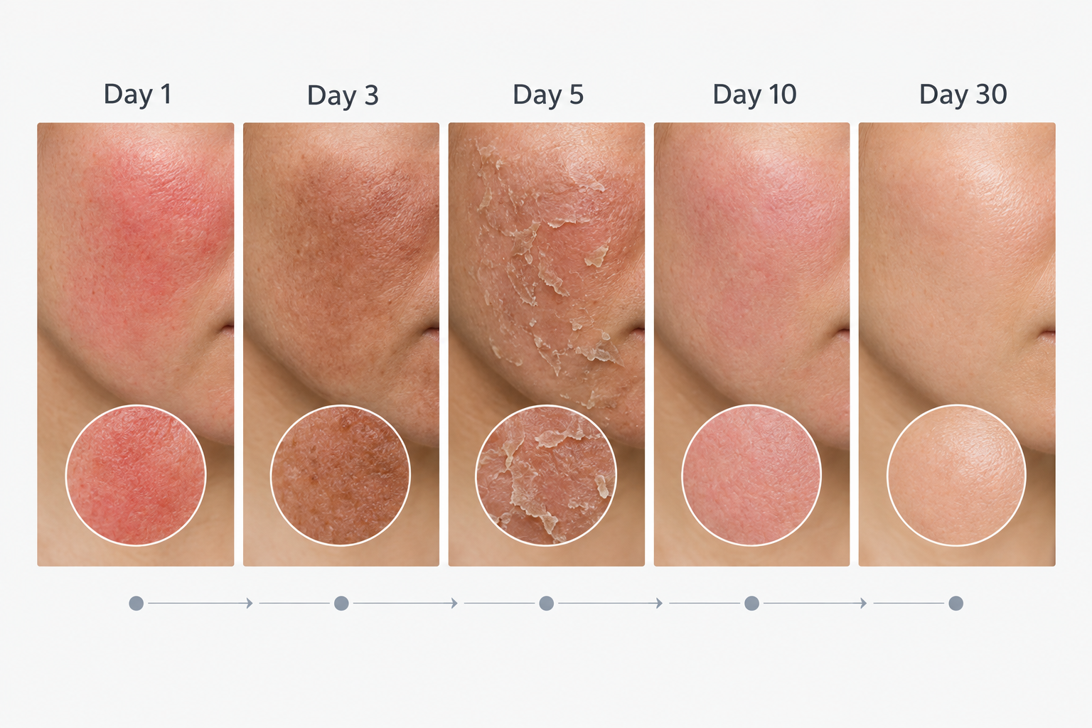 Chemical peel recovery timeline illustration showing skin changes from day one to day thirty