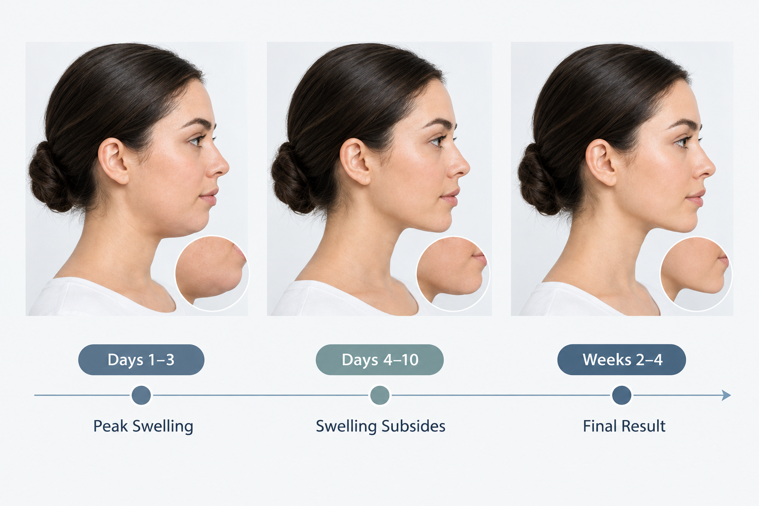 Timeline chart showing chin filler settling stages from day one to week four