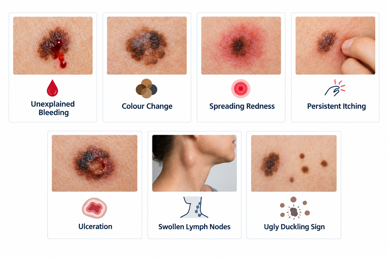 Fact cards showing urgent mole symptoms that require prompt medical assessment