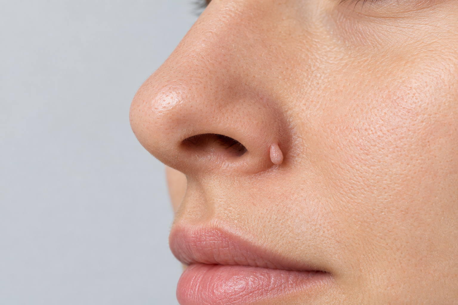 Illustration of a small skin tag on the side of the nose