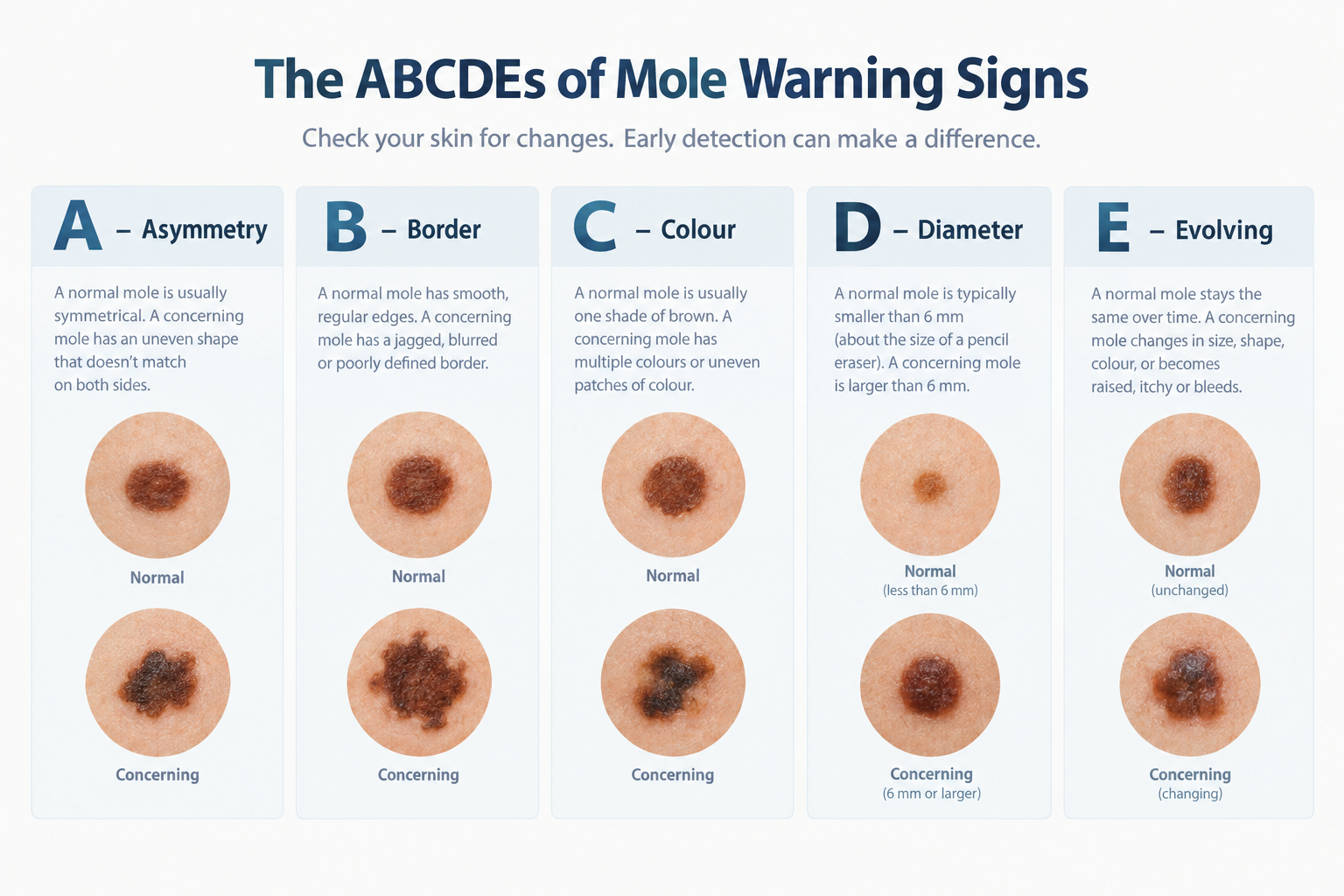 ABCDE mole warning signs infographic showing asymmetry, border, colour, diameter and evolving